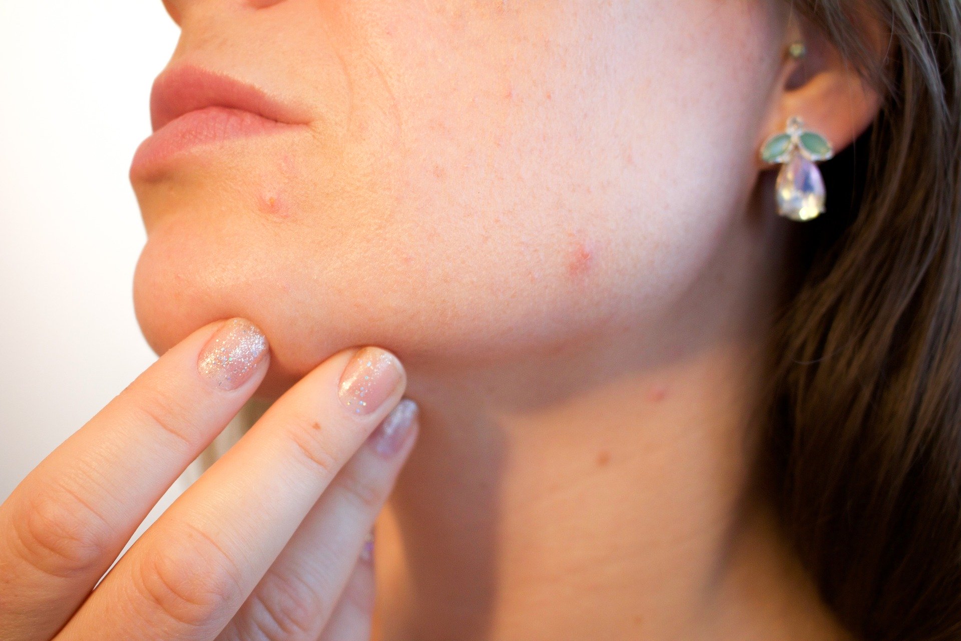 Get Rid of Acne Scars Forever: 7 Must-Try Acne Scar Treatments